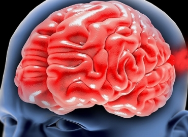 A hipertensão pode causar um aneurisma cerebral?