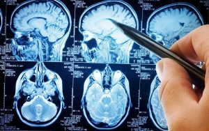 Quais os sintomas do tumor cerebral?